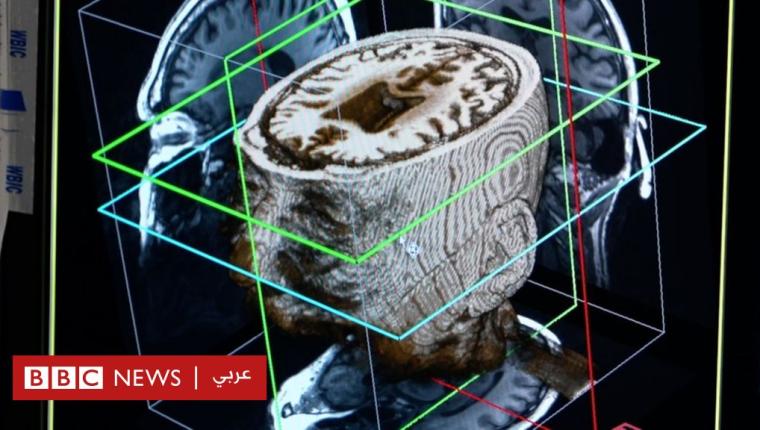 الخرف: نظام جديد للذكاء الصناعي قد يُشخص الحالة في يوم