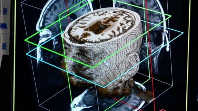 مسح للدماغ.